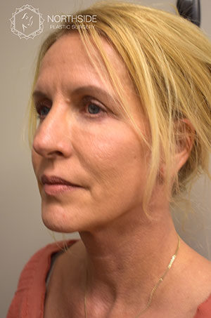 Sculptra Before and After | Northside Plastic Surgery