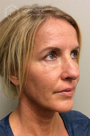 Sculptra Before and After | Northside Plastic Surgery
