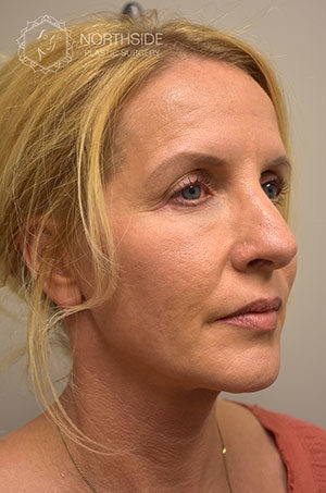 Sculptra Before and After | Northside Plastic Surgery